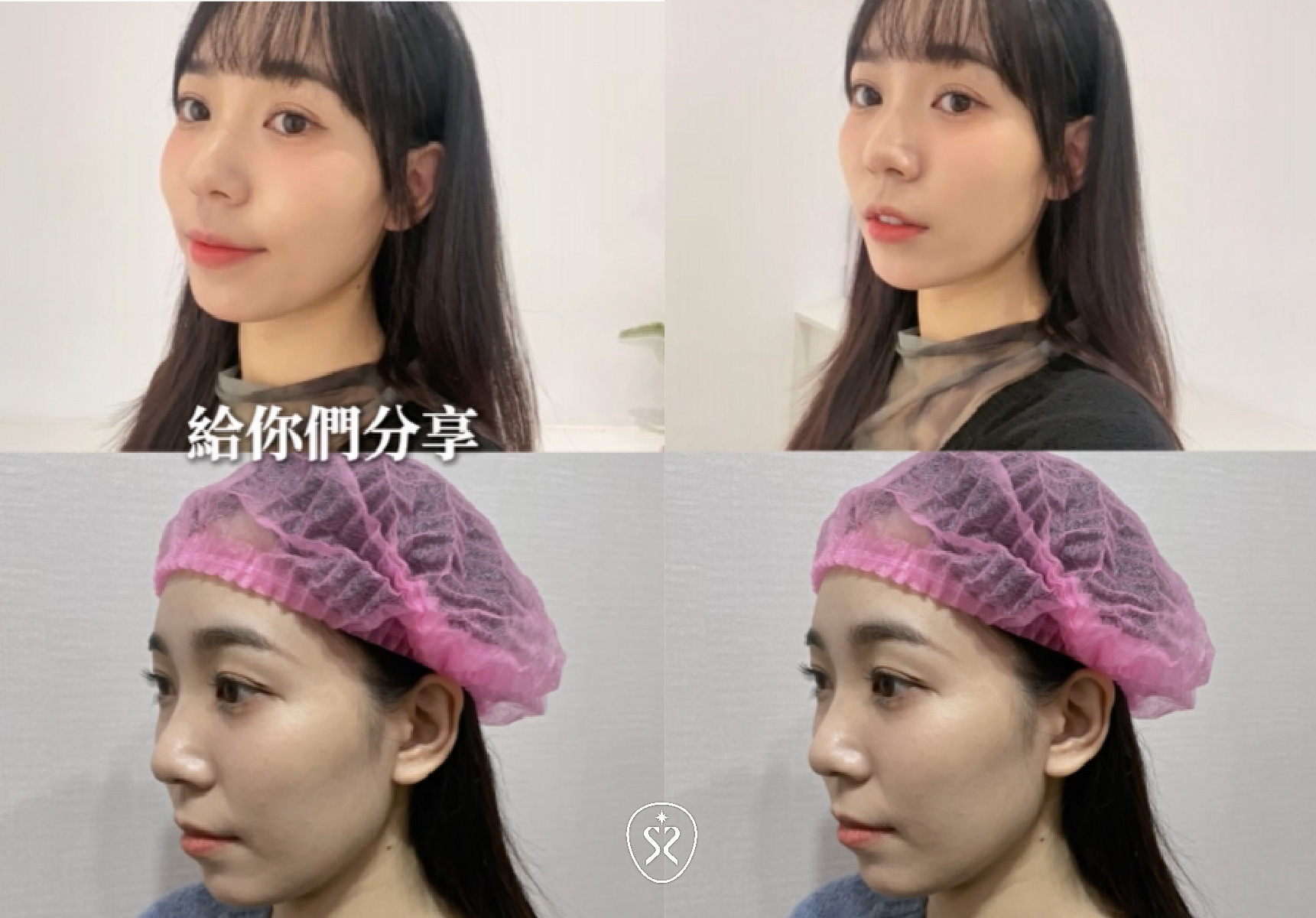 玩美電波的效果隨著膠原蛋白新生重組期間的2至6個月內感覺較為顯著